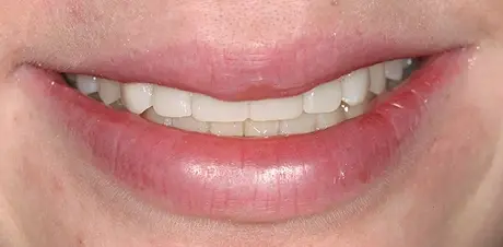 Close-up of a patient's smile after cosmetic dental treatment in Mineola, NY.