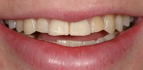 Before cosmetic dental treatment showing discolored and misaligned upper front teeth.