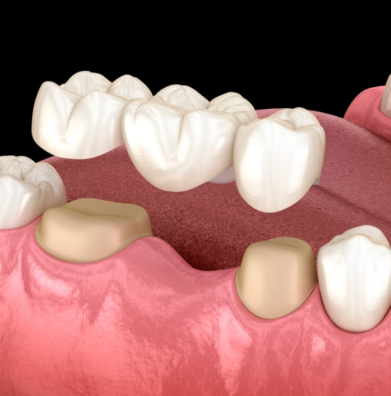 Replace Missing Teeth with Confidence