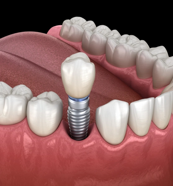 A Permanent Solution to Tooth Loss