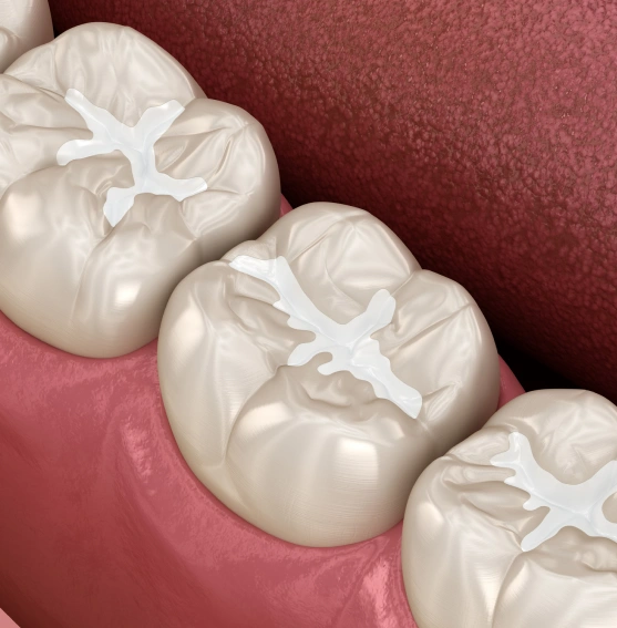A Simple, Effective Way to Prevent Tooth Decay