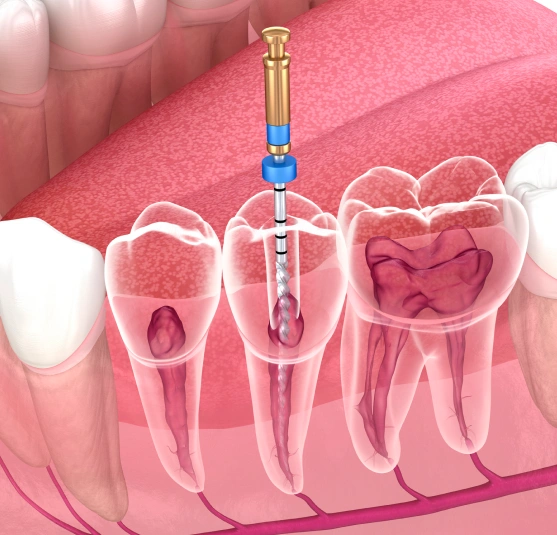 Specialized Care to Save Your Natural Teeth