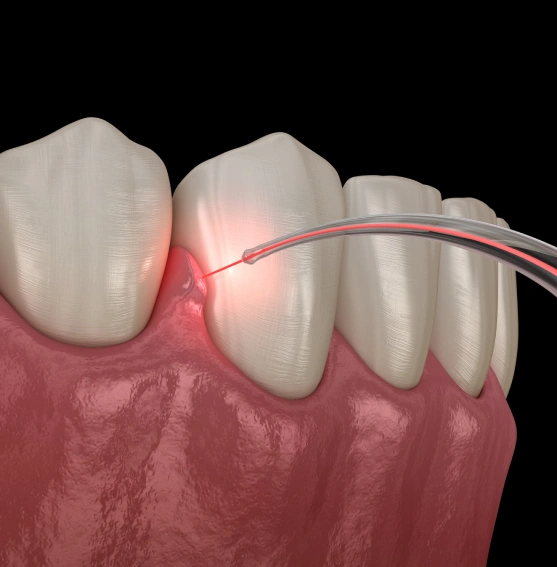 Advanced Laser Technology for Periodontal Care