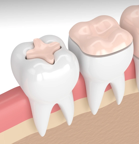 Restoring Teeth Beyond a Filling, Without a Full Crown