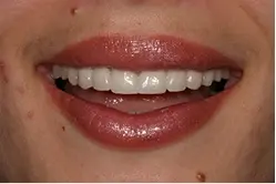 Bright smile showing straight white teeth after cosmetic dental treatment in Mineola.