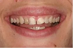 Patient smile before dental treatment showing misaligned and discolored teeth.