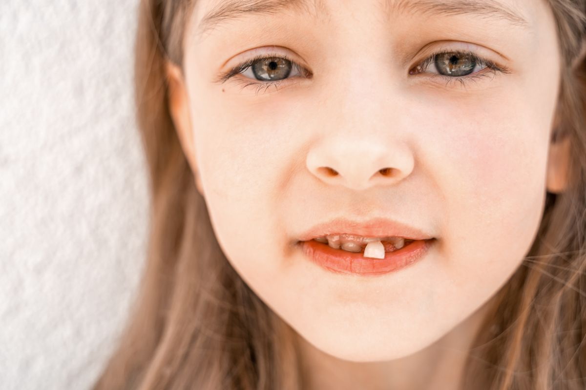 Child with a chipped front tooth after a dental injury