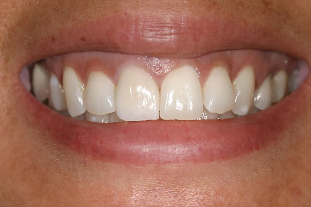 smile gallery photo
